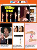 blue light pen solve Vitiligo,2025 NEW hot sale leg care tools