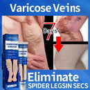 Varicose Vein Cream – Relieves Pain & Reduces Spider Veins ✅