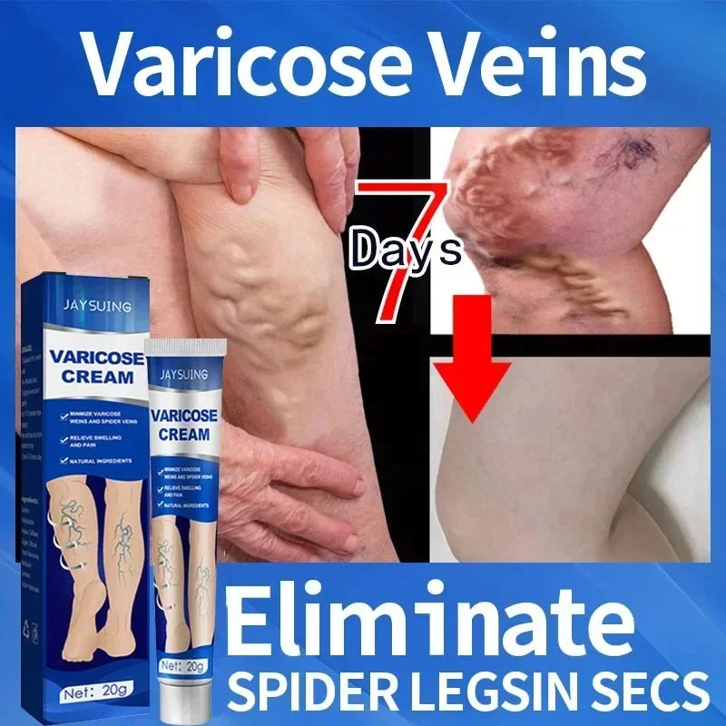 Varicose Vein Cream – Relieves Pain & Reduces Spider Veins ✅
