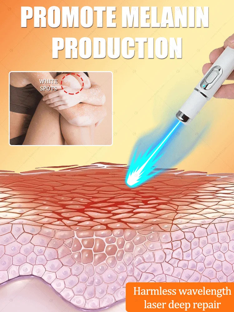 blue light pen solve Vitiligo,2025 NEW hot sale leg care tools