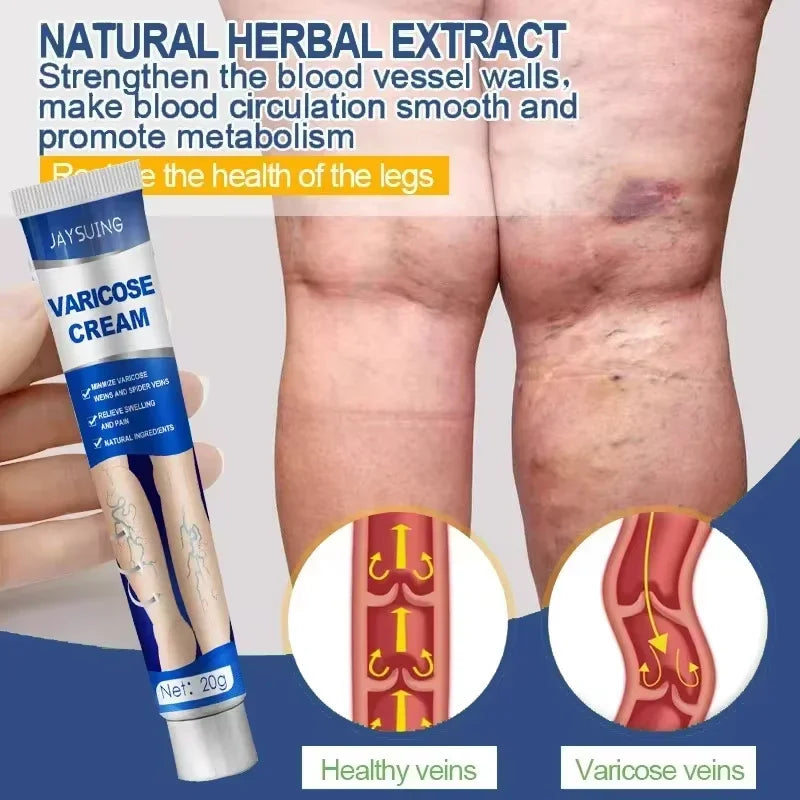 Varicose Vein Cream – Relieves Pain & Reduces Spider Veins ✅